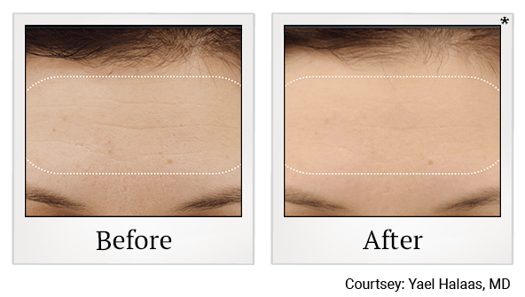 Results of EmFace treatment at True Form Medical Group in Oakland and Fremont