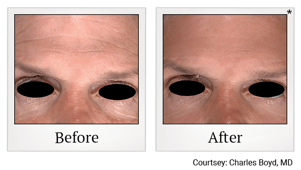 Results of EmFace treatment at True Form Medical Group in Oakland and Fremont