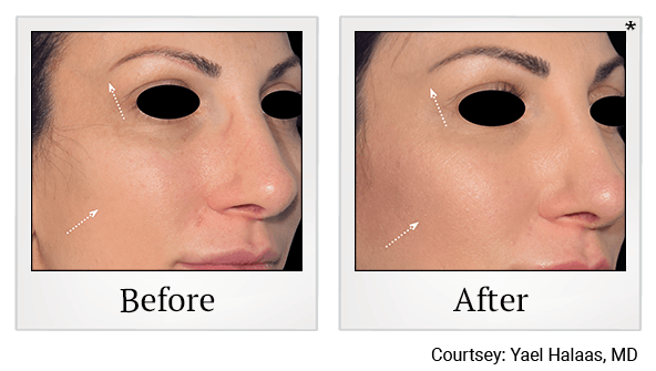 Results of EmFace treatment at True Form Medical Group in Oakland and Fremont