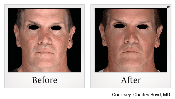 Results of EmFace treatment at True Form Medical Group in Oakland and Fremont