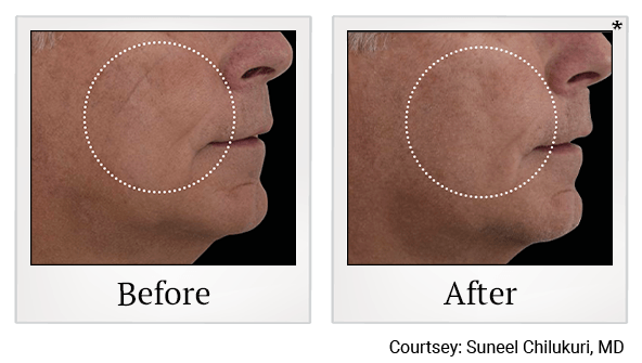 Results 12 of EmFace treatment at True Form Medical Group in Fremont and Oakland