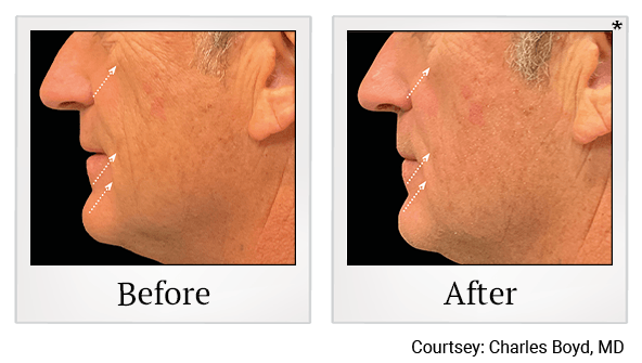 Results 21 of EmFace treatment at True Form Medical Group in Fremont and Oakland