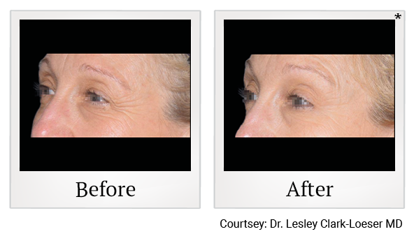 Results 22 of EmFace treatment at True Form Medical Group in Fremont and Oakland