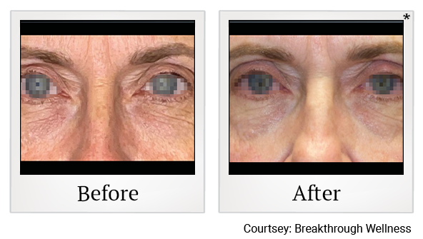 Results 24 of EmFace treatment at True Form Medical Group in Fremont and Oakland