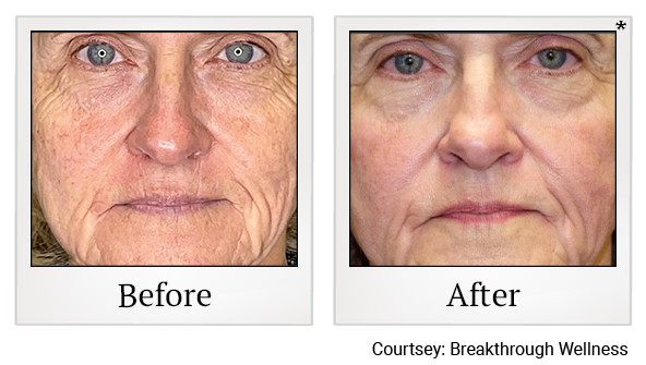 Results 27 of EmFace treatment at True Form Medical Group in Fremont and Oakland