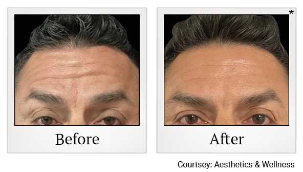 Results 2 of EmFace treatment at True Form Medical Group in Fremont and Oakland