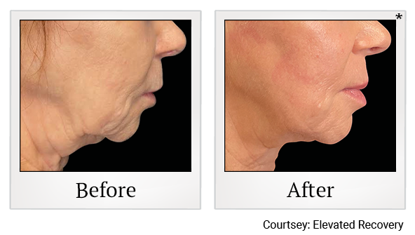 Results 5 of EmFace treatment at True Form Medical Group in Fremont and Oakland