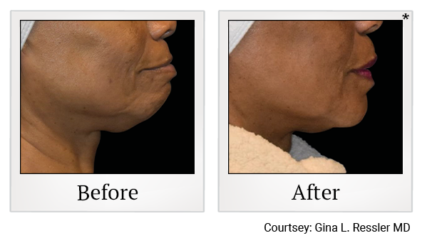 Results 7 of EmFace treatment at True Form Medical Group in Fremont and Oakland