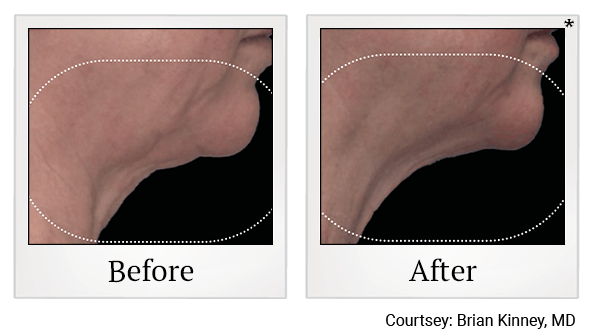 Results 8 of EmFace treatment at True Form Medical Group in Fremont and Oakland