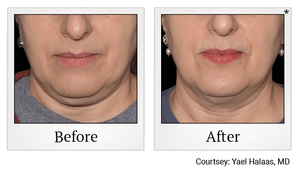 Results 9 of EmFace treatment at True Form Medical Group in Fremont and Oakland