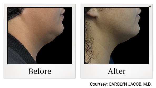 Results 11 of EmFace treatment at True Form Medical Group in Fremont and Oakland