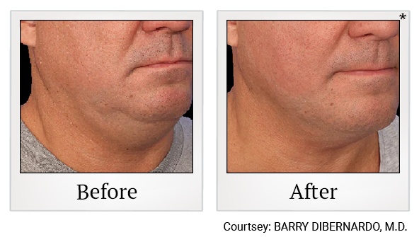 Results 13 of EmFace treatment at True Form Medical Group in Fremont and Oakland