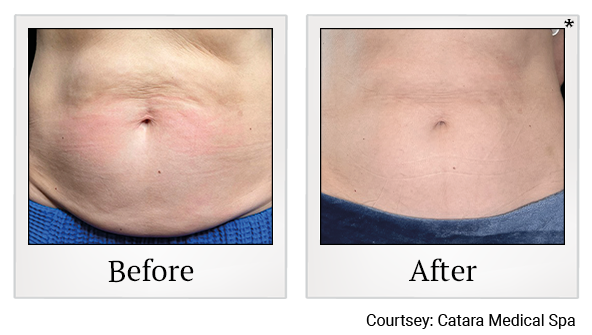 Results 3 of emsculpt neo treatment at True Form Medical Group in Fremont and Oakland