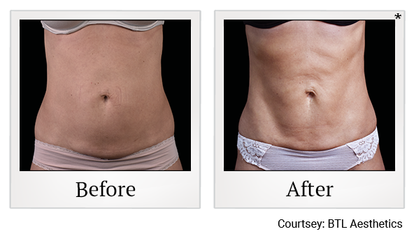 Results 2 of emsculpt neo treatment at True Form Medical Group in Fremont and Oakland