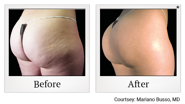 Results 14 of emsculpt neo treatment at True Form Medical Group in Fremont and Oakland