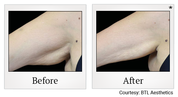 Results 4 of emtone treatment at True Form Medical Group in Fremont and Oakland