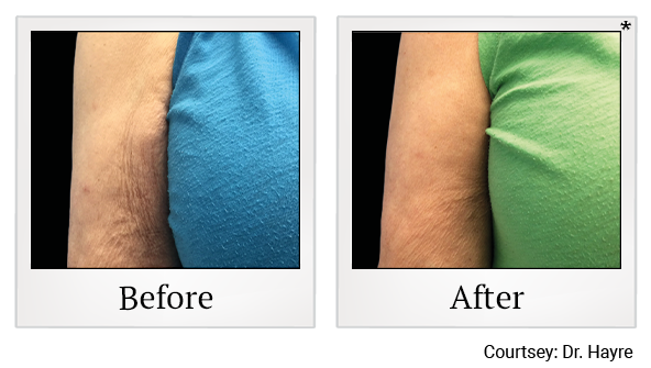 Results 5 of emtone treatment at True Form Medical Group in Fremont and Oakland