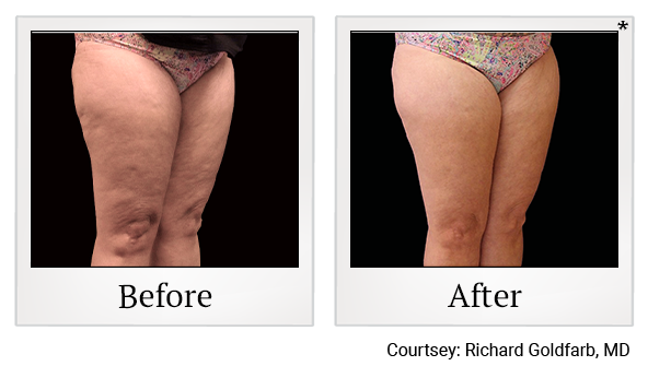 Results 4 of emtone treatment at True Form Medical Group in Fremont and Oakland